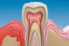 Tratamentul gingiilor - salvarea dinţilor