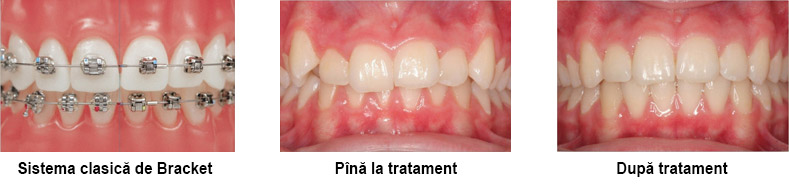 Ortodontia Chisinau Bracket aparat dentar