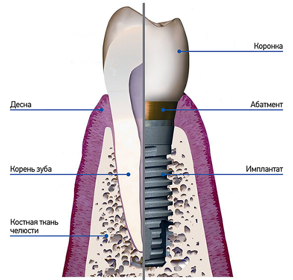 зубной имплант Кишинев