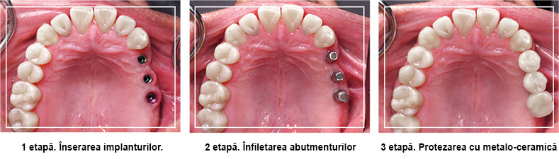 Implantarea dentara in Chisinau