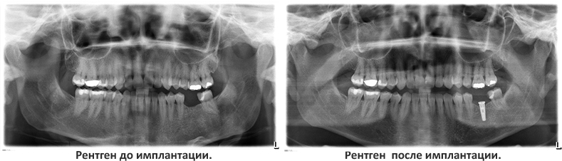 Рентген имплаплантация зубов Кишинев