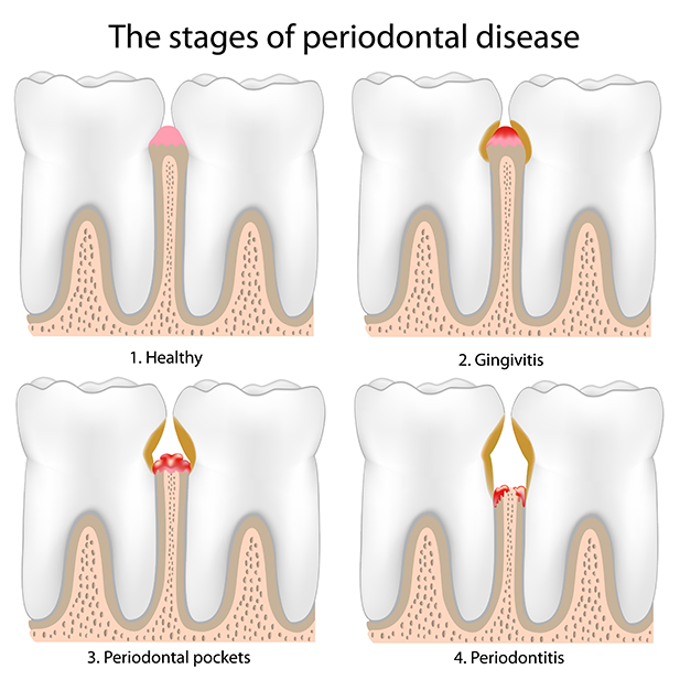 Periodontitis treatment in Chisinau