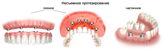 несъемные зубные протезы кишинев протезирование