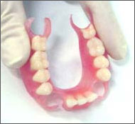 Removable nylon dentures in Moldova