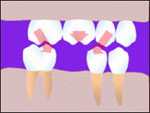 Tooth loss