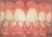 Treatmnet of gingivitis in Chisinau