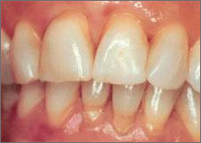 Gingivitis treatment