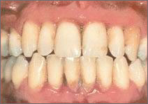 Treatment of periodontitis in Chisinau