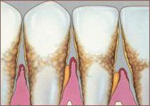 View of periodontitis