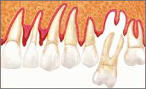 Tooth losses