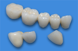 Ceramic-metal denture Chisinau