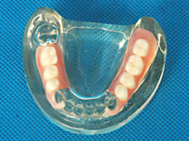 Partial dental prosthesis in Moldova