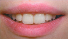 Tooths after dental restoration