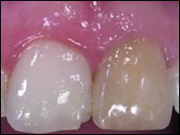 Tooths before dental restoration