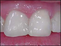 Tooths after dental restoration